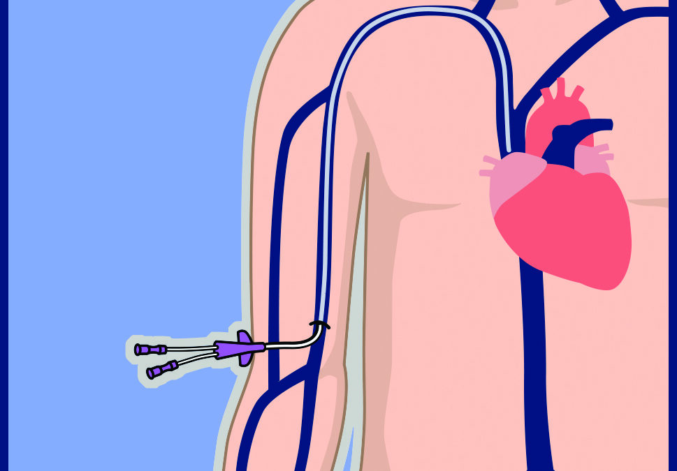 Where Is a PICC Line Placed