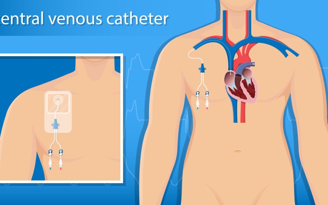What are the types of Central Venous Catheters?