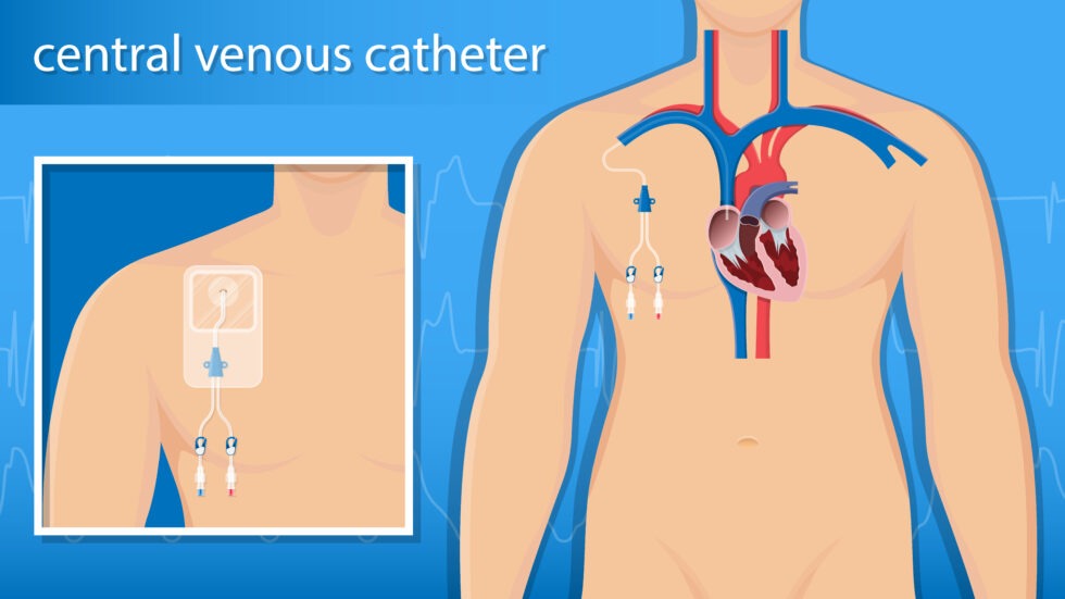 What are the types of Central Venous Catheters? | Vascular Wellness