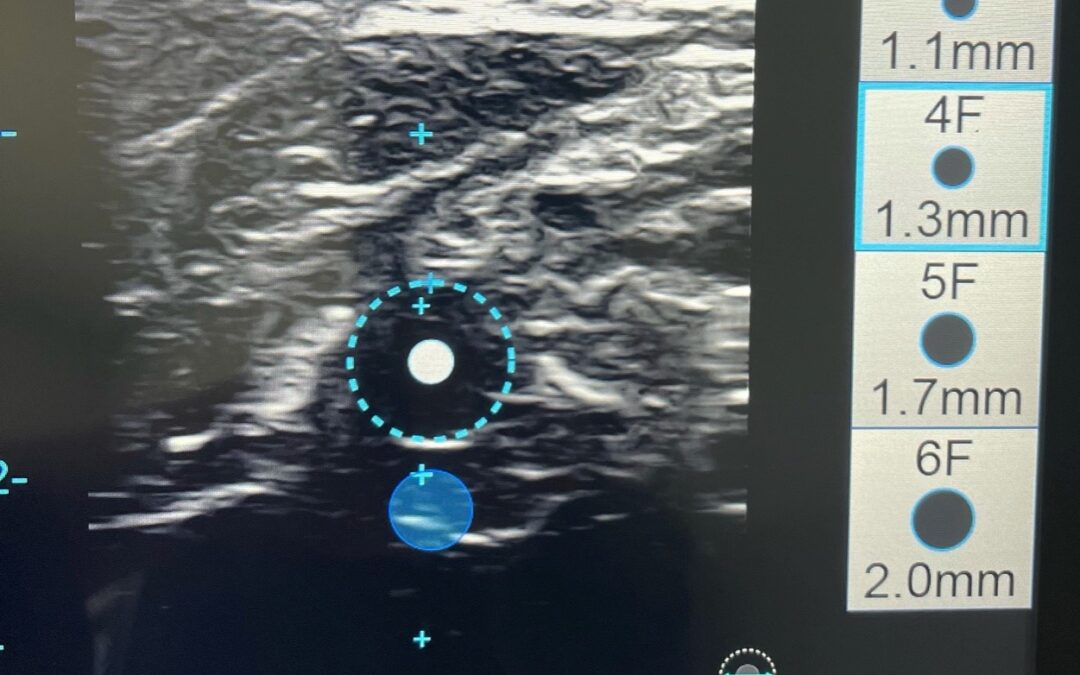 How to reduce the risk of Upper Extremity DVTs in connection with PICCs and other Central Lines?