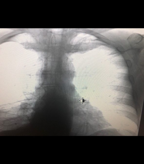 Pinch-Off Syndrome – Nurse Clinicians in Action-01