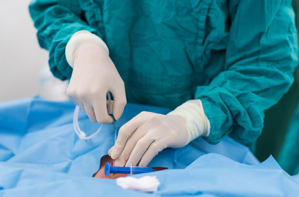 Central Venous Catheter