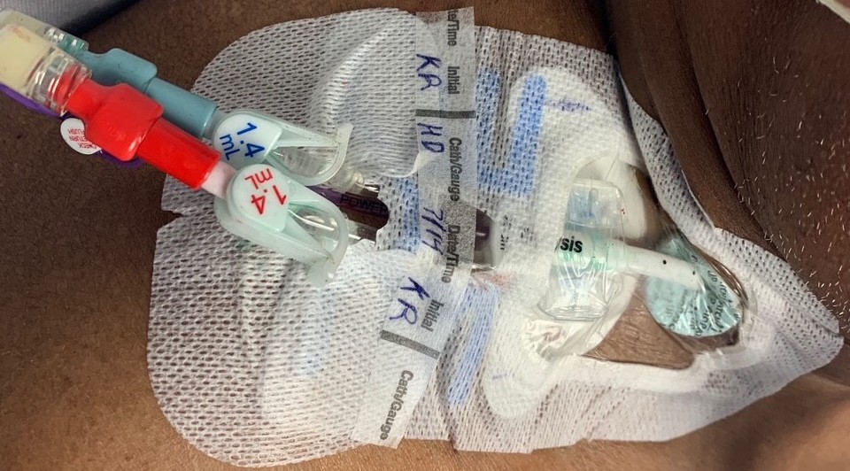 Dialysis catheter placement by Vascular Wellness