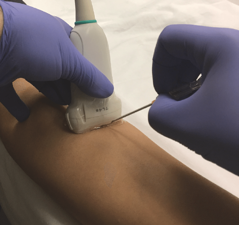 Peripheral IV Placement using Ultrasound