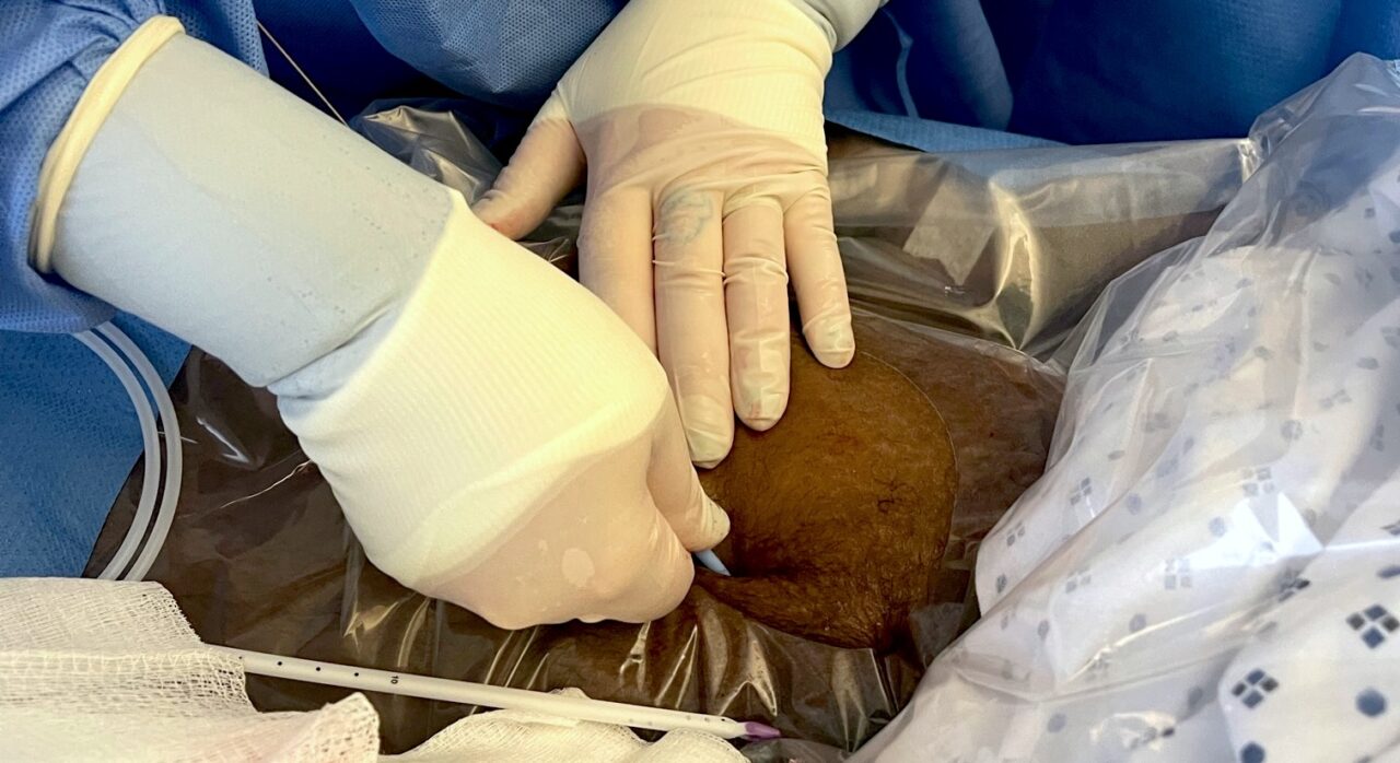 Nurseplaced Dialysis Catheters at the Bedside Vascular Wellness