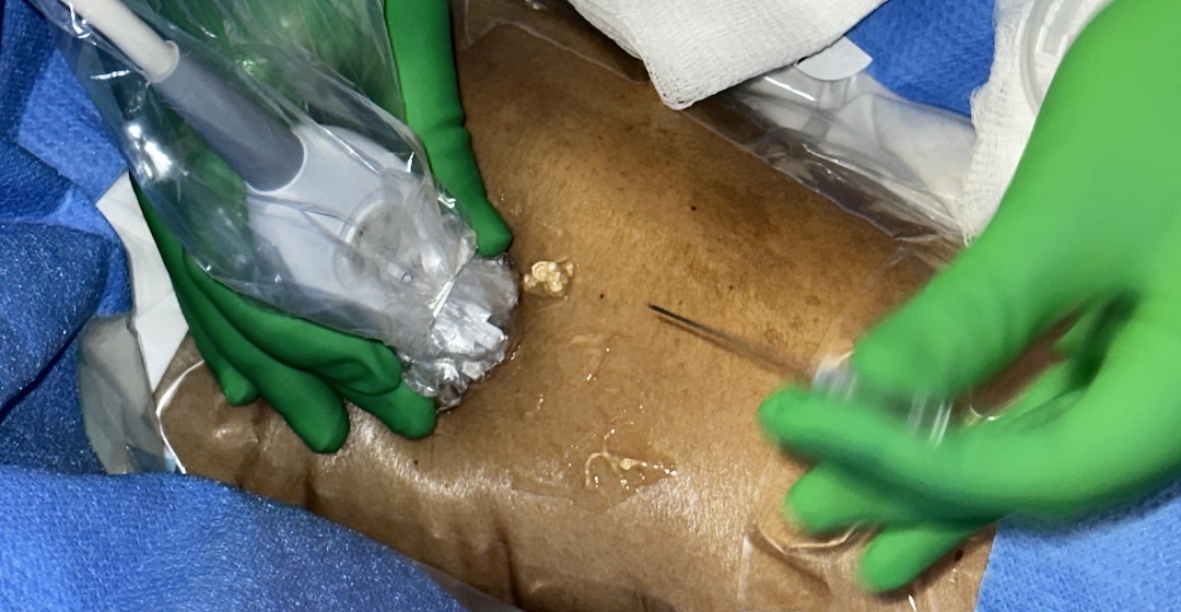 Bilateral Arm Amputation Requires Emergent Vascular Access – Nurse Clinicians in Action – 26