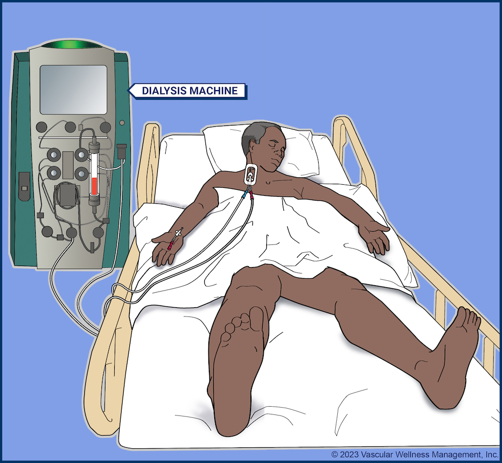 Vascular Access for Temporary dialysis illustration from Vascular Wellness