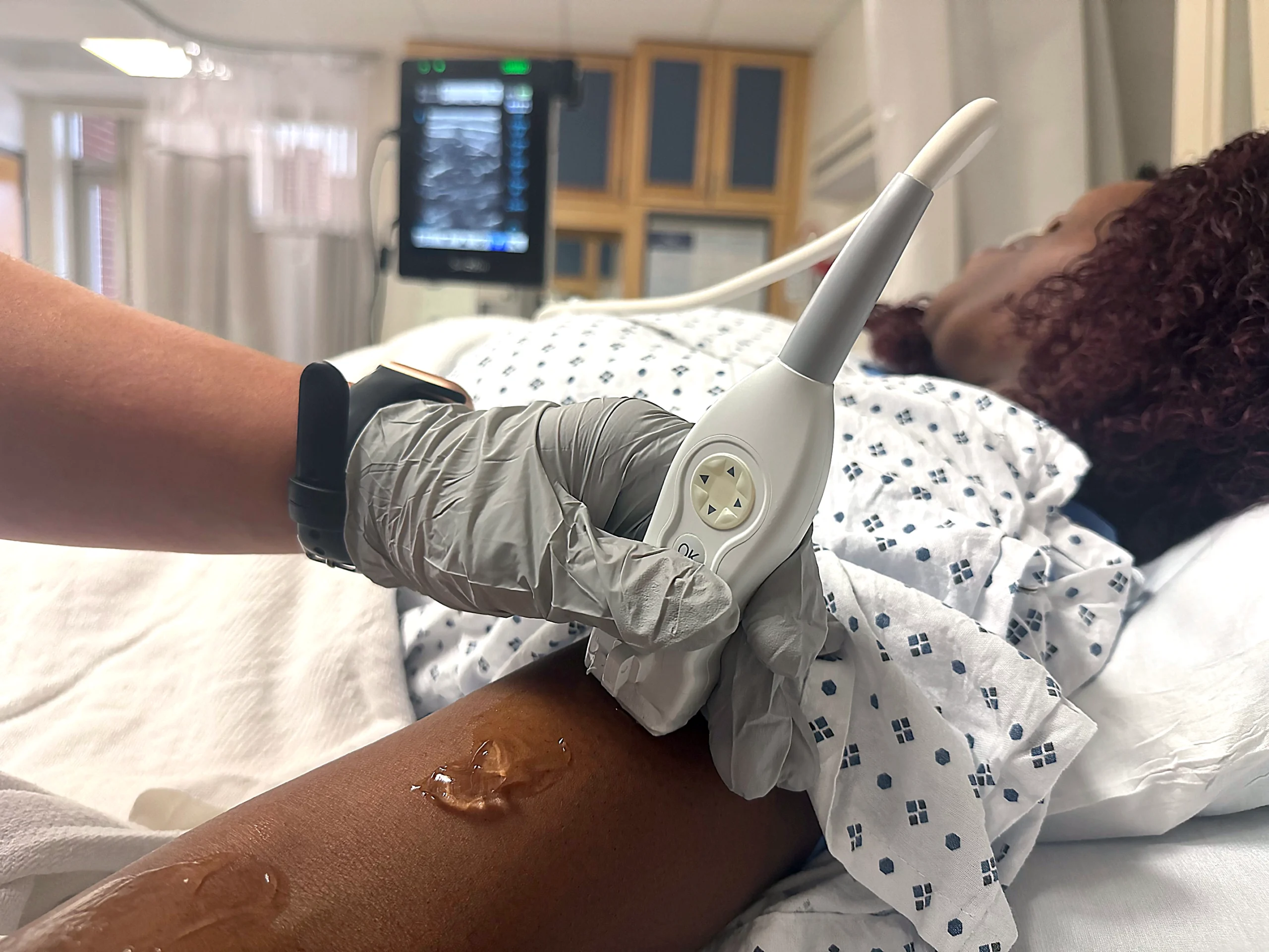 Vascular-access-ultrasound-scan-13 Vascular access ultrasound vein visualization