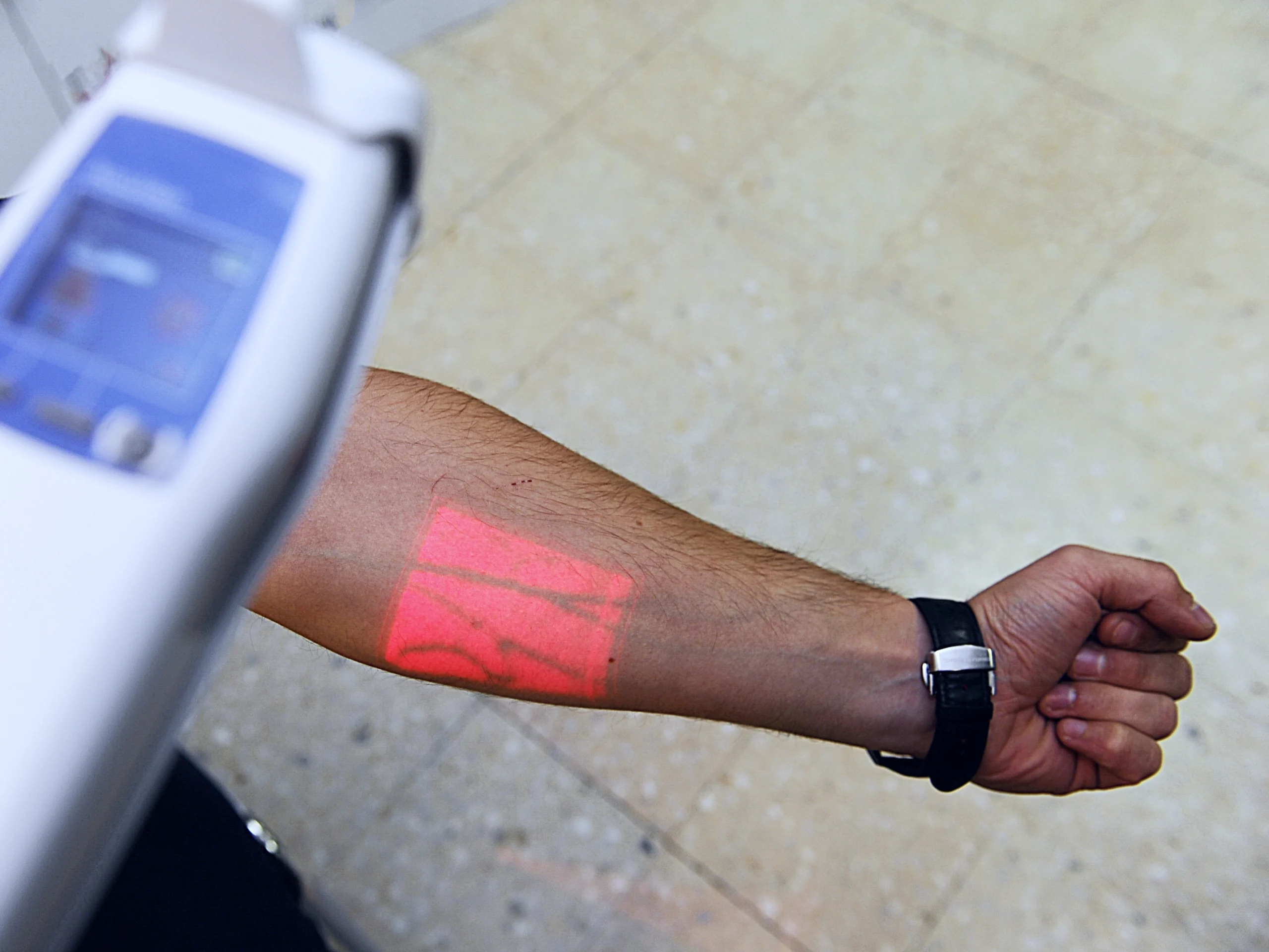 vein visualization using vein finder Vein visualization using a vein finder