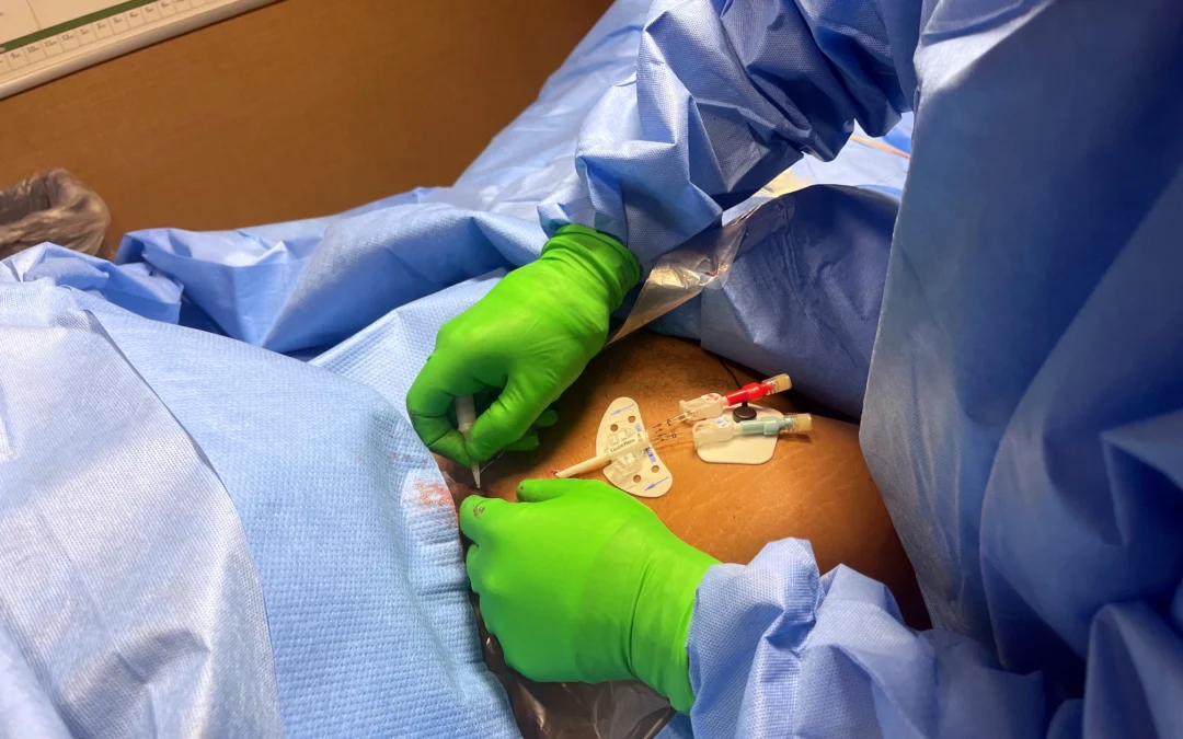 Vascath Exchanged to Tunneled Permcath – Nurse Clinicians in Action – 43