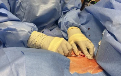 Same Day Tunneled Permcath at the Bedside – Nurse Clinicians in Action – 53