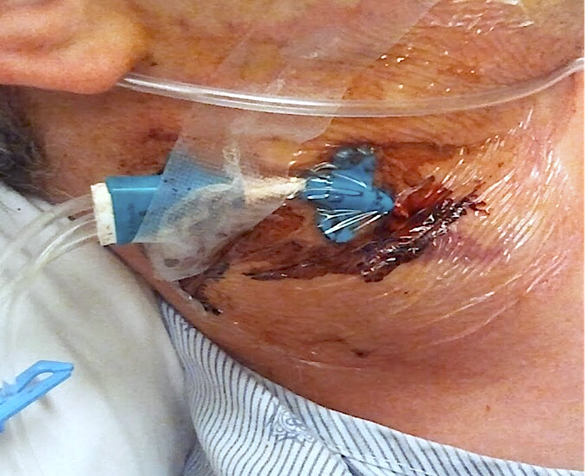 Improper catheter care can lead to CLABSIs or CRBSIs