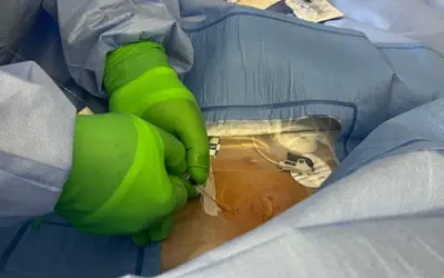 Urgent Vascath and Axillary Line – Nurse Clinicians in Action – 56